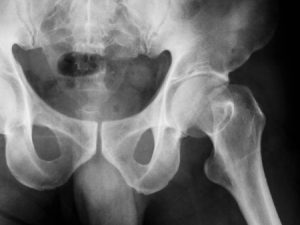 Acetabulum fracture compensation claims