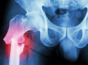 Broken neck of femur fracture compensation claims