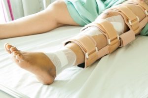 Fibula fracture compensation