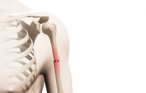 Humerus fracture compensation