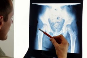 Pelvic fracture compensation claims guide