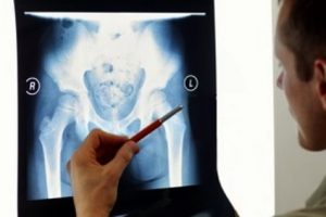 Pubic Rami fracture compensation claims guide