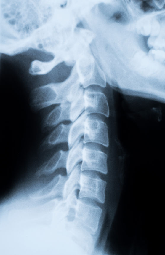 Cudahy Scaphoid Fracture Compensation thumbnail