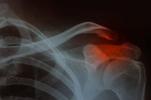 broken collarbone compensation 