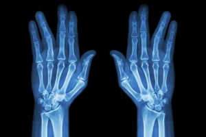 Distal radius fracture compensation 