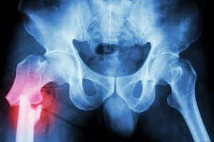 Femur fracture compensation claims 