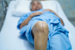 fractured patella compensation