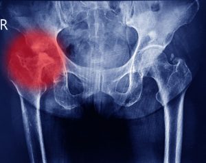 hip fracture compensation
