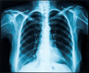 scapula fracture compensation