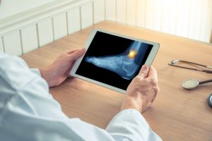 Talus fracture compensation claims 