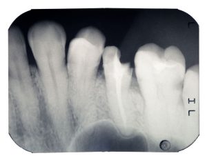tooth fracture compensation 