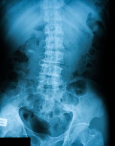 Sacral fracture compensation claims 