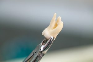 Wrong Tooth Extraction