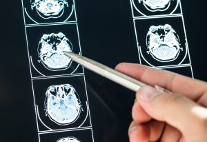 brain cancer misdiagnosed