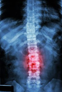 serious back injury claim