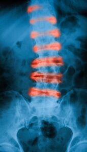 Hospital missed lumbar fracture
