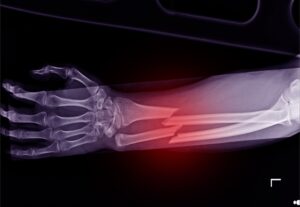An x ray of a broken wrist with a red pulse around the break