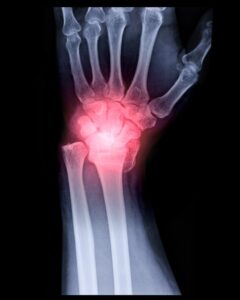 An x-ray image of a distal radius with a break that glows red