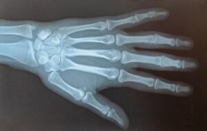 An x-ray image of a distal radius fracture