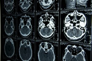 Images of MRI brain scans, which can be used in an epilepsy diagnosis