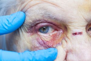Close up of bruising around an elderly person's eye
