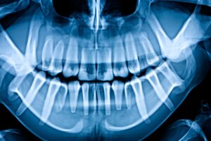 An X-ray scan image of a full set of teeth. 