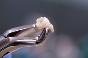 A dental plier holding an extracted tooth after a dentist pulled the wrong tooth.