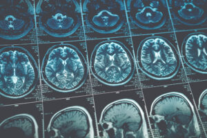 SEQUENCE OF BRAIN CAT SCANS
