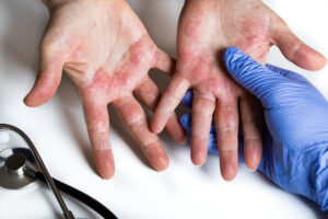 A person has hand an allergic reaction on their hands.