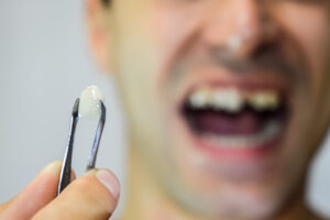 Someone holding an extracted tooth with some tweezers.