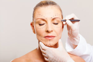 A middle-aged woman with correction lines on her face before getting cosmetic surgery.