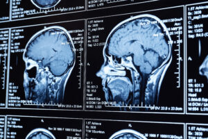 An x-ray brain scan of malignant tumours 