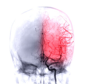 A graphic highlighting one side of a brain to indicate a traumatic injury