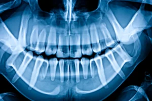 An X-ray scan of a patient's jaw.
