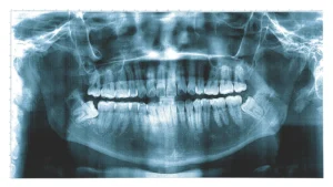 An X-ray scan of a patients jaw and teeth.